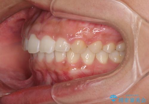 気になる出っ歯とすきっ歯をインビザラインで改善の治療後