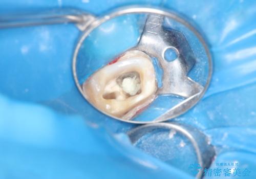 金属だらけの奥歯　根管治療のやり直しとセラミック化の治療中