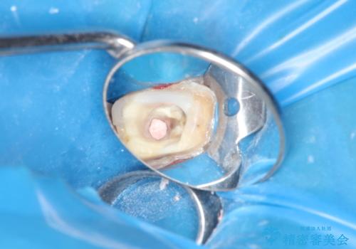 金属だらけの奥歯 根管治療のやり直しとセラミック化の治療中