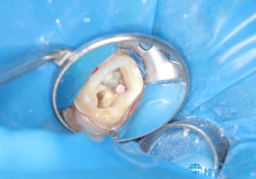 金属だらけの奥歯 根管治療のやり直しとセラミック化の治療中