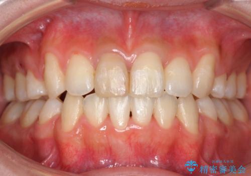 八重歯　前歯のがたがた　抜歯してワイヤー矯正の症例 治療後