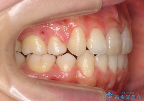 八重歯 前歯のがたがた 抜歯してワイヤー矯正の治療後