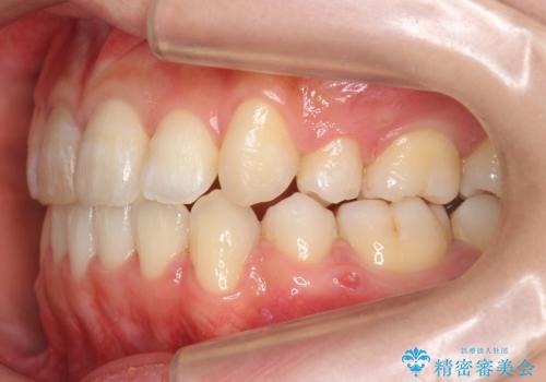 八重歯　前歯のがたがた　抜歯してワイヤー矯正の治療後