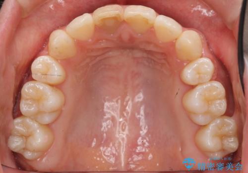 八重歯 前歯のがたがた 抜歯してワイヤー矯正の治療後