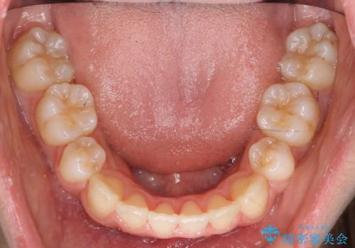 八重歯　前歯のがたがた　抜歯してワイヤー矯正の治療後