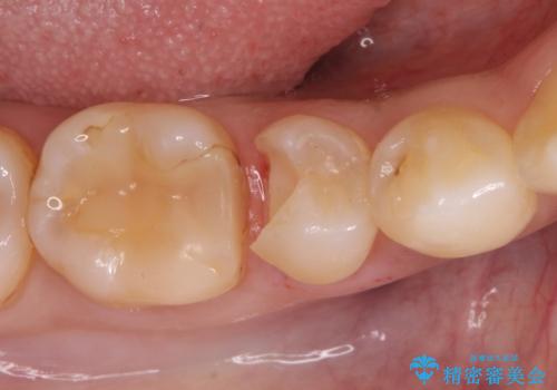 虫歯の治療 セラミックの詰め物で綺麗にの治療中