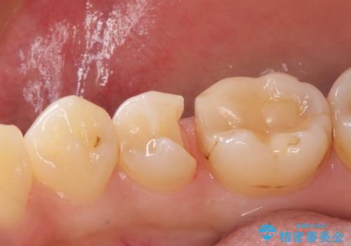 虫歯の治療 セラミックの詰め物で綺麗にの治療中