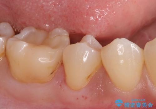 虫歯の治療 セラミックの詰め物で綺麗にの治療中
