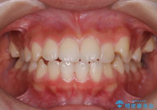 ハーフリンガル 半分裏側矯正による上下前突の抜歯矯正治療の治療前