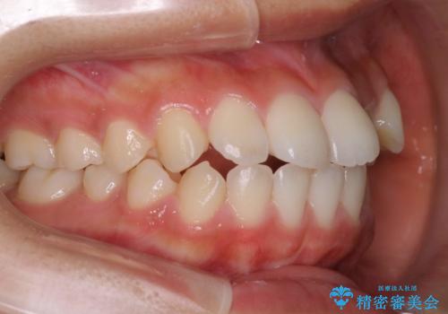 ハーフリンガル　半分裏側矯正による上下前突の抜歯矯正治療の症例 治療前