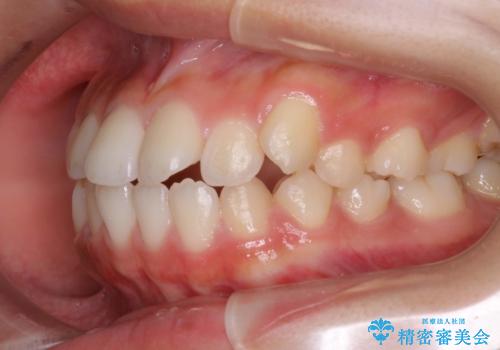 ハーフリンガル 半分裏側矯正による上下前突の抜歯矯正治療の治療前