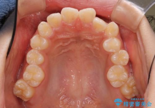 ハーフリンガル 半分裏側矯正による上下前突の抜歯矯正治療の治療前