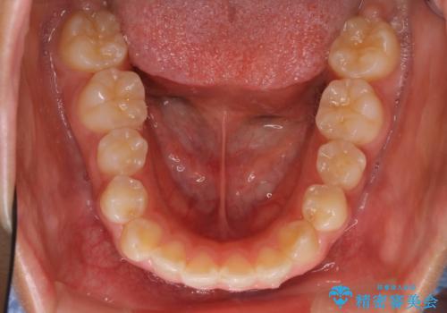 ハーフリンガル　半分裏側矯正による上下前突の抜歯矯正治療の治療前