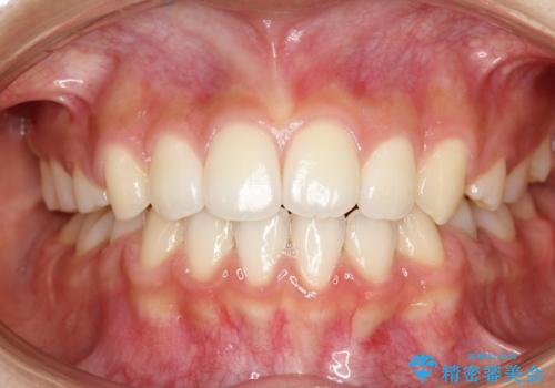 ハーフリンガル 半分裏側矯正による上下前突の抜歯矯正治療の治療後
