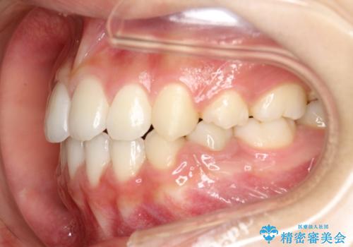 ハーフリンガル　半分裏側矯正による上下前突の抜歯矯正治療の治療後