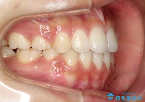 ハーフリンガル　半分裏側矯正による上下前突の抜歯矯正治療の症例 治療後