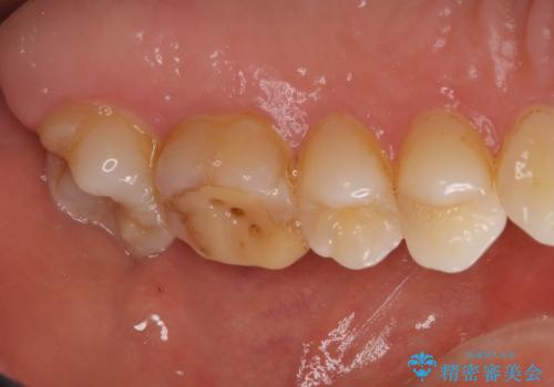 海外転勤前にセラミック治療の治療前