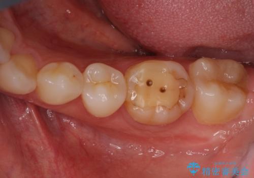 海外転勤前にセラミック治療の治療前