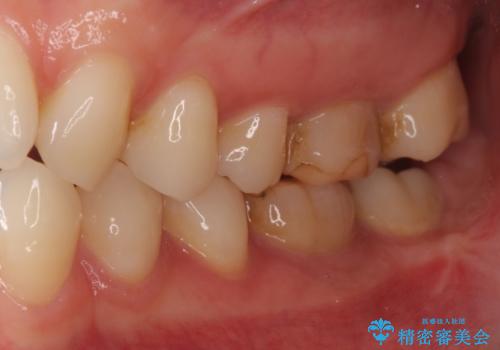 海外転勤前にセラミック治療の症例 治療前