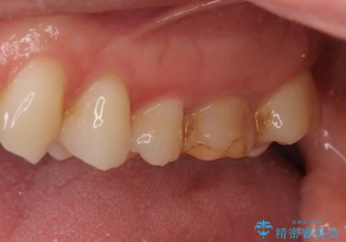 海外転勤前にセラミック治療の治療前
