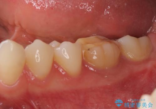 海外転勤前にセラミック治療の治療前