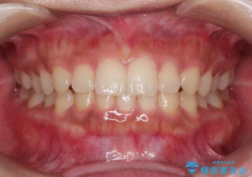 前歯の隙間を閉じたい。インビザラインによる治療の治療後