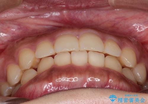 前歯の隙間を閉じたい。インビザラインによる治療の症例 治療後