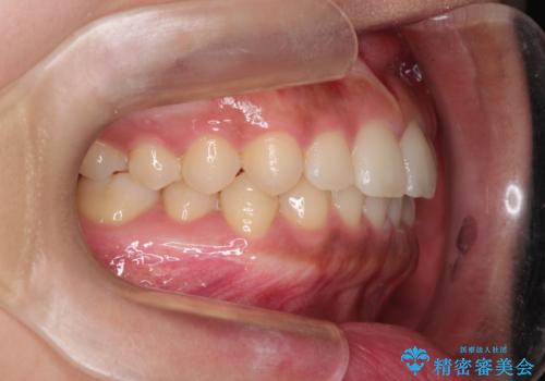 前歯の隙間を閉じたい。インビザラインによる治療の治療後