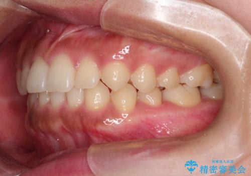 前歯の隙間を閉じたい。インビザラインによる治療の治療後