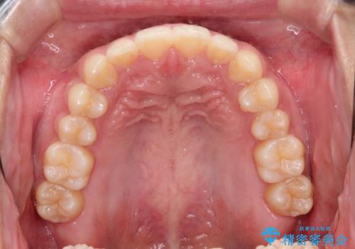 前歯の隙間を閉じたい。インビザラインによる治療の治療後