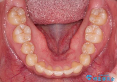 前歯の隙間を閉じたい。インビザラインによる治療の治療後