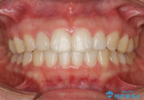 Invisalign インビザライン lite ライト 隙っ歯の改善の症例 治療後