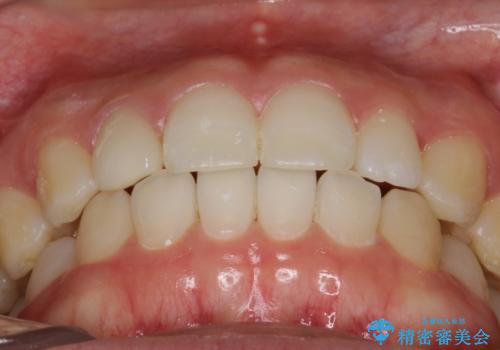 Invisalign インビザライン lite ライト 隙っ歯の改善の治療後