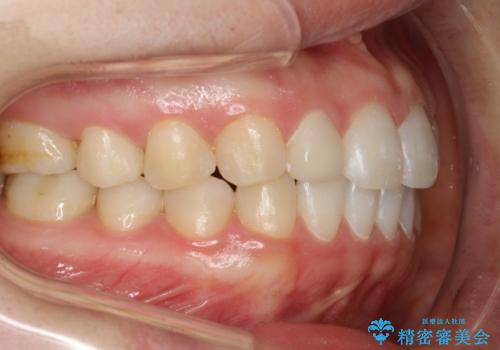 Invisalign インビザライン lite ライト 隙っ歯の改善の治療後
