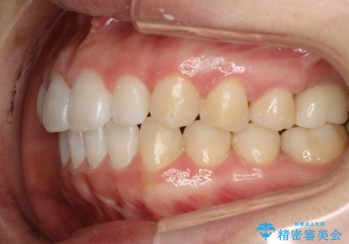 Invisalign インビザライン lite ライト 隙っ歯の改善の治療後