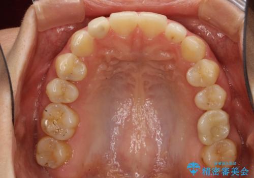 Invisalign インビザライン lite ライト 隙っ歯の改善の治療後