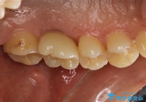 奥歯が割れてしまった! → インプラントによるかみ合わせの回復の治療後