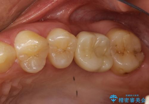 奥歯が割れてしまった! → インプラントによるかみ合わせの回復の症例 治療後