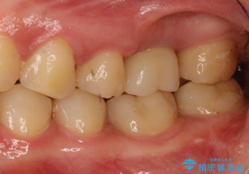奥歯が割れてしまった! → インプラントによるかみ合わせの回復の治療後