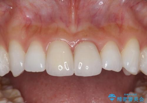 前歯の長さを揃える　歯周外科とセラミックの治療後