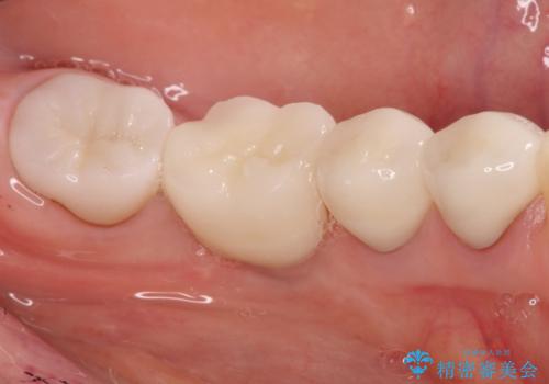骨が薄い部位への骨造成をともなうインプラントの治療後