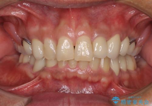 奥歯で物を噛めるようにしたい 入れ歯による咬合回復の治療後