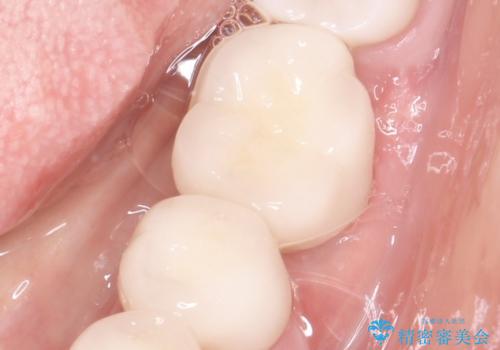 骨が薄い部位への骨造成をともなうインプラントの治療後