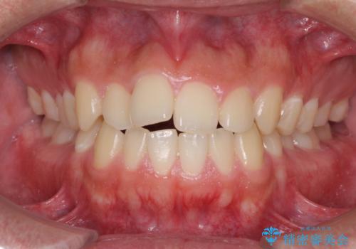 前歯のデコボコをワイヤー矯正で速やかに改善の症例 治療前