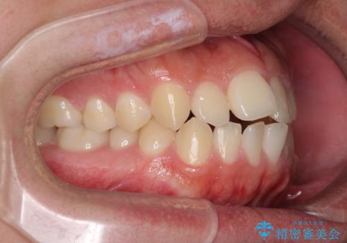 前歯のデコボコをワイヤー矯正で速やかに改善の治療前