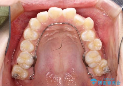 ハーフリンガル　半分裏側矯正による上下前突の抜歯矯正治療の治療中