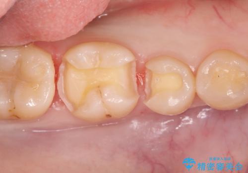 自然な見た目のセラミックインレーの治療中
