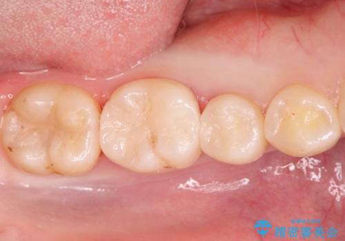 自然な見た目のセラミックインレーの治療後