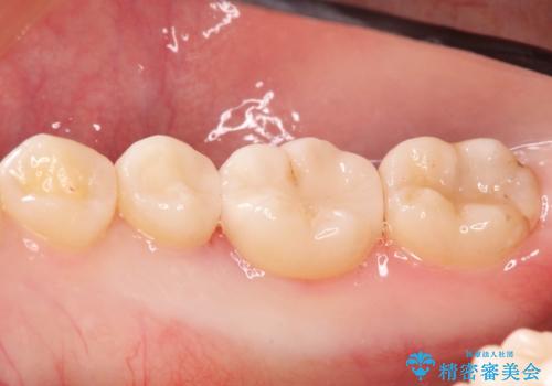 自然な見た目のセラミックインレーの治療後