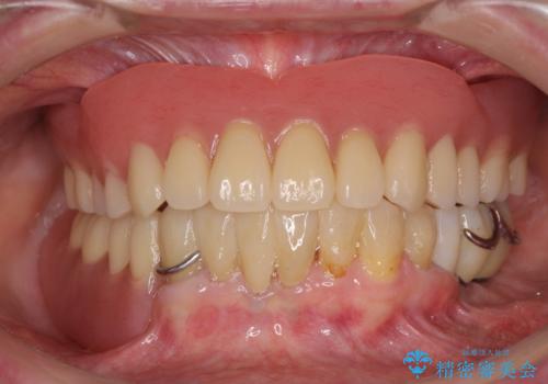 インプラントと入れ歯による全顎補綴治療の症例 治療後
